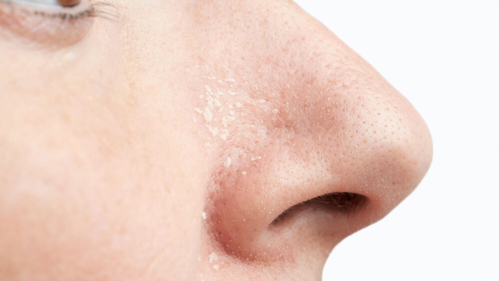دلیل اصلی خشکی پوست بینی + راه‌های درمان آن