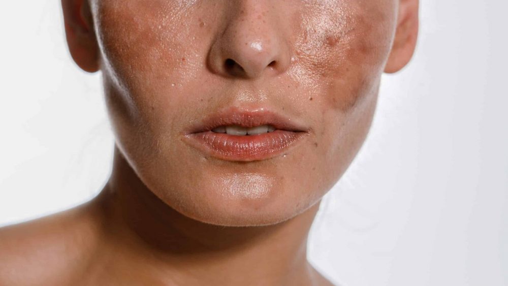 سد پوستی چیست؟ چگونه می‌توان از آن محافظت کرد؟