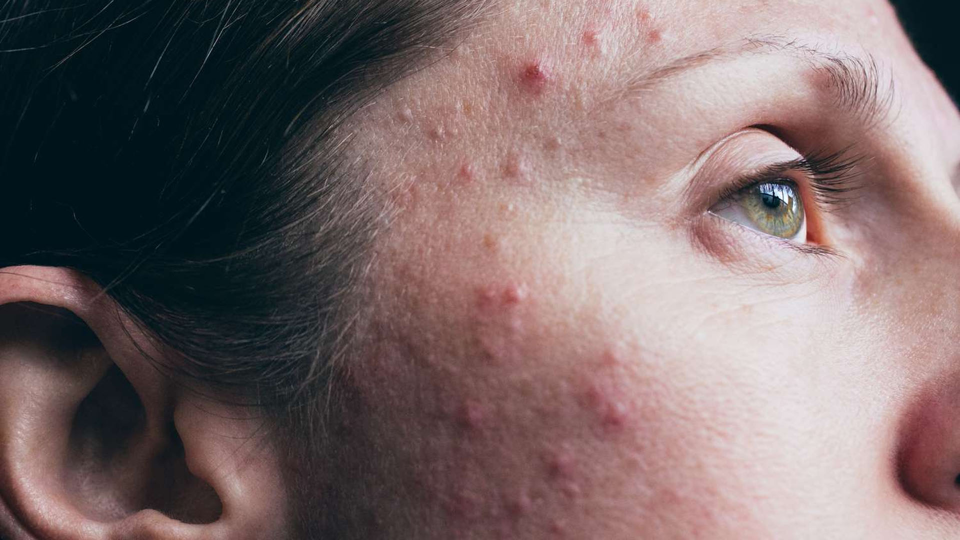 چطور یک روتین پوستی با ترکیبات ضدآکنه ملایم طراحی کنیم؟