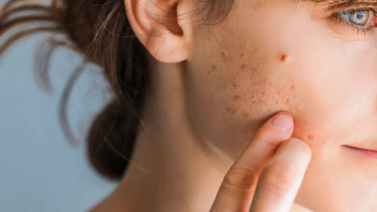 تفاوت جوشهای التهابی و غیرالتهابی + روش برخورد با هر کدام
